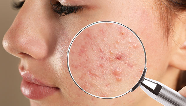 acne therapie